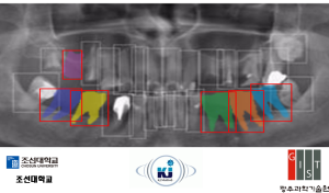 Development of artificial intelligence implant guide simulation software and surgical guide system 이미지